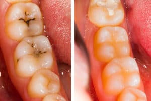 cropped White fillings 300x290 1