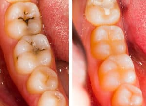cropped White fillings 300x290 2