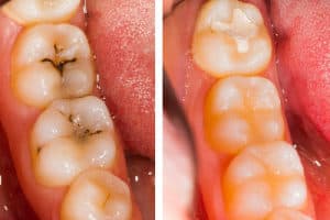 cropped White fillings 300x290