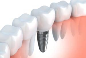 Dental Implant with Crown