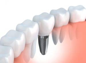 cropped dentalimplant e1580680368601