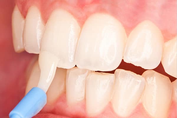 cropped fluoride treatment