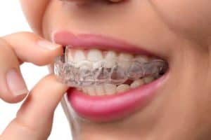 cropped invisalign process