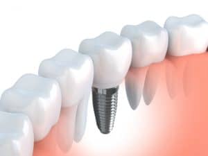 Dental Implant to restore teeth after they have been lost