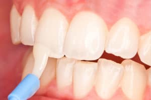 Tooth treated with Fluoride