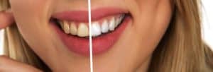 Teeth Whitening - before and after