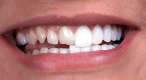 Tooth veneers