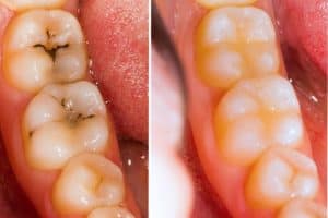 metal and tooth colored fillings