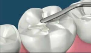 White Filling in a Molar Tooth to restore tooth surface