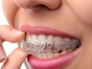 Invisalign braces