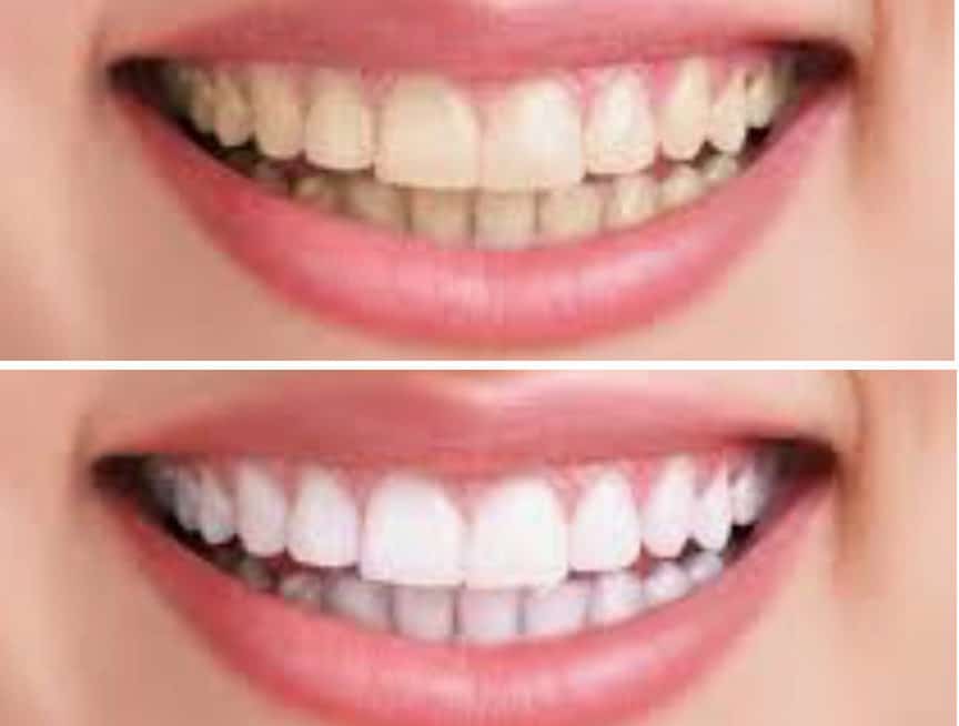 cropped teethwhitening 2