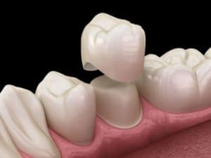 Dental Crown on a Molar Tooth