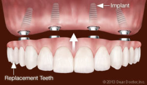 Implanted Bridge