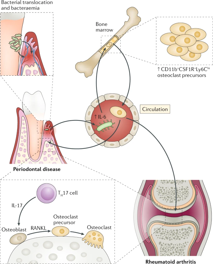 Periodontitis and Arthritis Infographic